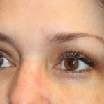 Blepharoplasty Before & After Patient #30581