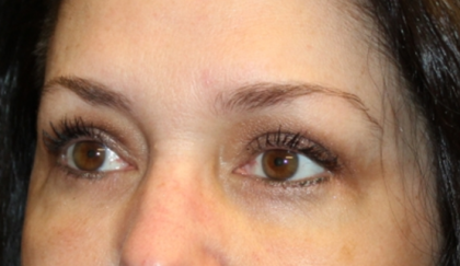 Blepharoplasty Before & After Patient #30581