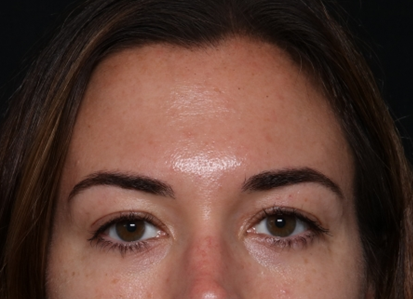 Botox and Dysport Before & After Patient #30471