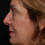 Facelift Before & After Patient #30487