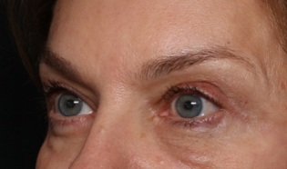 Blepharoplasty Before & After Patient #30512