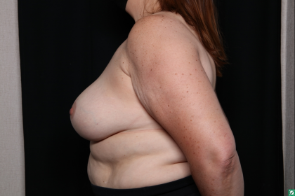 Breast Reduction Before & After Patient #30541