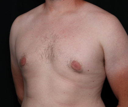 Gynecomastia Before & After Patient #30625