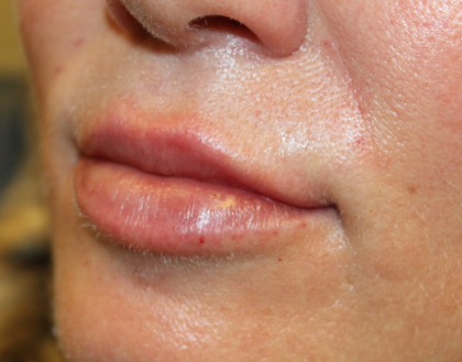 Lip Filler Before & After Patient #30636