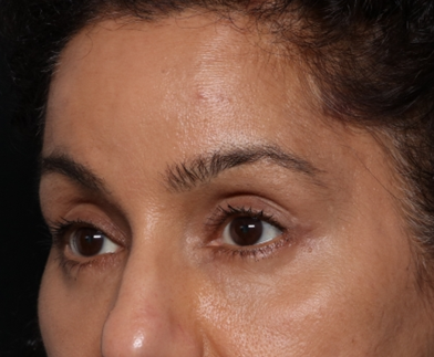 Brow Lift Before & After Patient #30678