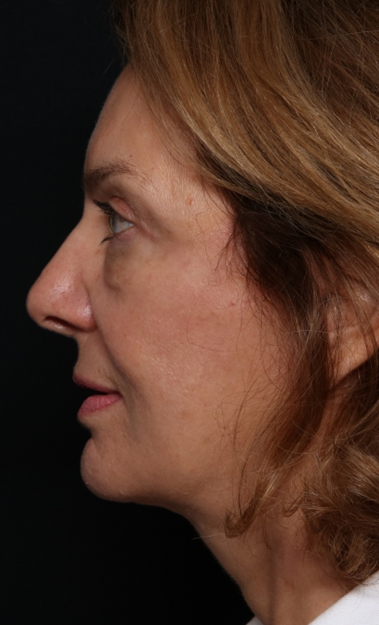 Facelift Before & After Patient #30487