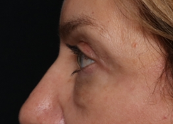 Blepharoplasty Before & After Patient #30512