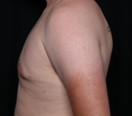 Gynecomastia Before & After Patient #30625