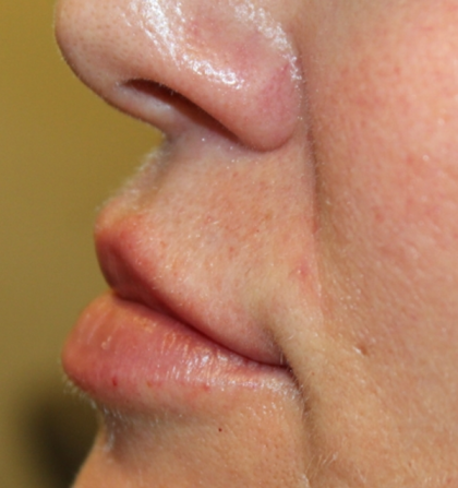 Lip Filler Before & After Patient #30636