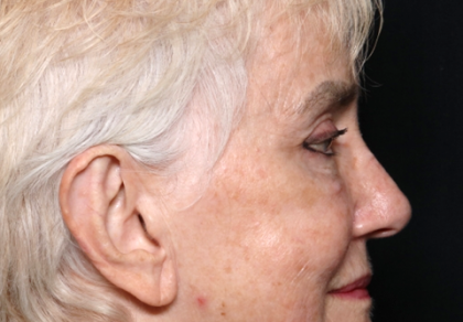 Blepharoplasty and Brow Lift Before & After Patient #30496