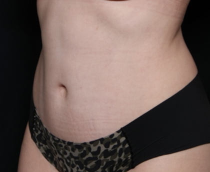 Tummy Tuck Before & After Patient #30647