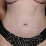 Tummy Tuck Before & After Patient #30647