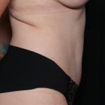 Tummy Tuck Before & After Patient #30647