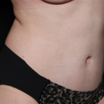 Tummy Tuck Before & After Patient #30647