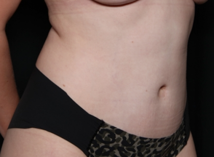 Tummy Tuck Before & After Patient #30647