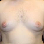 Gynecomastia Before & After Patient #30625