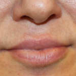Lip Filler Before & After Patient #30636