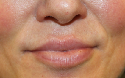 Lip Filler Before & After Patient #30636