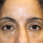 Brow Lift Before & After Patient #30678