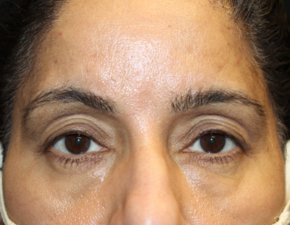 Brow Lift Before & After Patient #30678