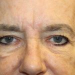 Blepharoplasty and Brow Lift Before & After Patient #30496