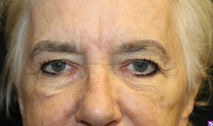 Blepharoplasty and Brow Lift Before & After Patient #30496