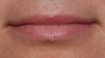 Lip Filler Before & After Patient #30507