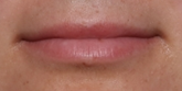 Lip Filler Before & After Patient #30507