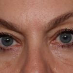 Blepharoplasty Before & After Patient #30512