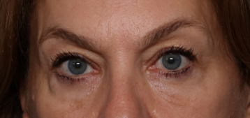 Blepharoplasty Before & After Patient #30512