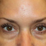 Blepharoplasty Before & After Patient #30581