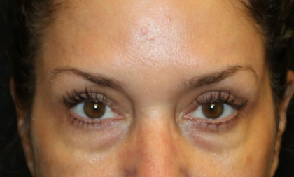 Blepharoplasty Before & After Patient #30581