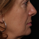 Facelift Before & After Patient #30487