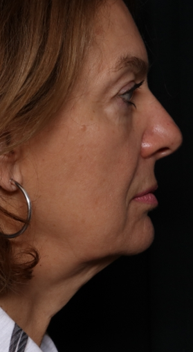 Facelift Before & After Patient #30487
