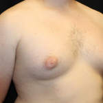 Gynecomastia Before & After Patient #30625