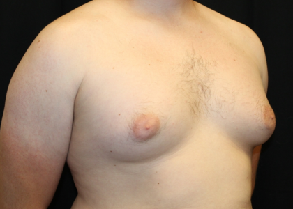 Gynecomastia Before & After Patient #30625