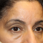 Brow Lift Before & After Patient #30678