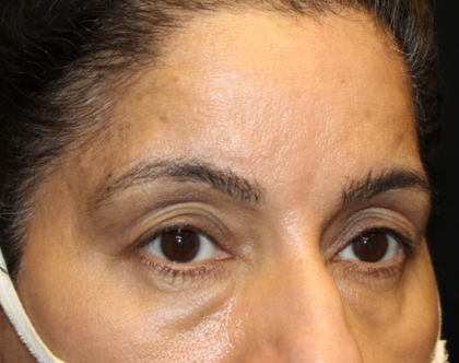 Brow Lift Before & After Patient #30678