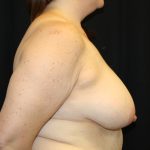 Breast Reduction Before & After Patient #30541