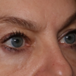 Blepharoplasty Before & After Patient #30512