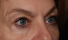 Blepharoplasty Before & After Patient #30512