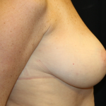 Breast Lift Before & After Patient #30523