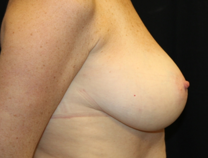 Breast Lift Before & After Patient #30523