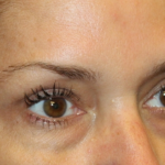 Blepharoplasty Before & After Patient #30581