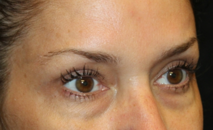 Blepharoplasty Before & After Patient #30581