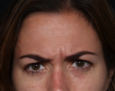 Botox and Dysport Before & After Patient #30471