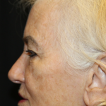 Blepharoplasty and Brow Lift Before & After Patient #30496
