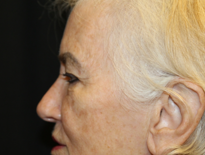 Blepharoplasty and Brow Lift Before & After Patient #30496