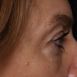 Blepharoplasty Before & After Patient #30512