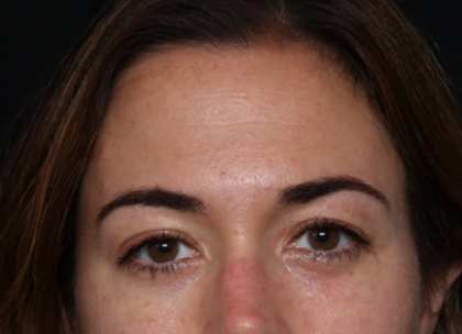 Botox and Dysport Before & After Patient #30471